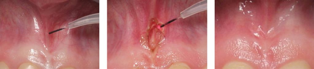 Before, during and after photo of frenectomy