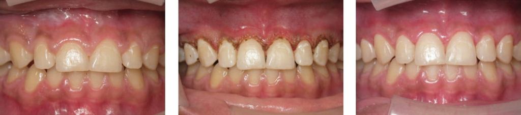 Before, during, and after healing of gingivectomy