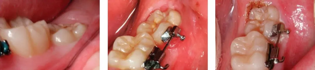 Before and after photos of Operculectomy