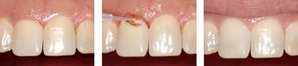 Before, during, and after photos of gum recontouring