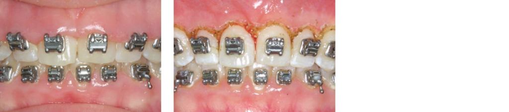 before and after hyperplasia-gummy smile correction