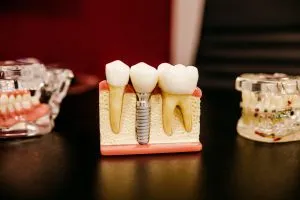 Image of dental implant model on table