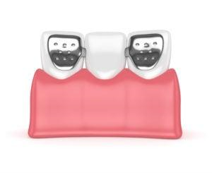 3D illustration of a fixed dental bridge: two abutment crowns with metal frameworks supporting a pontic tooth, seated on pink gingiva — demonstrating tooth replacement