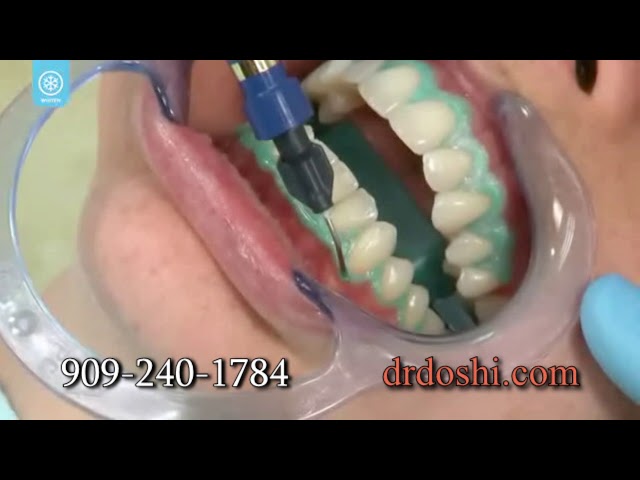 Whitening in the office for 20 min.